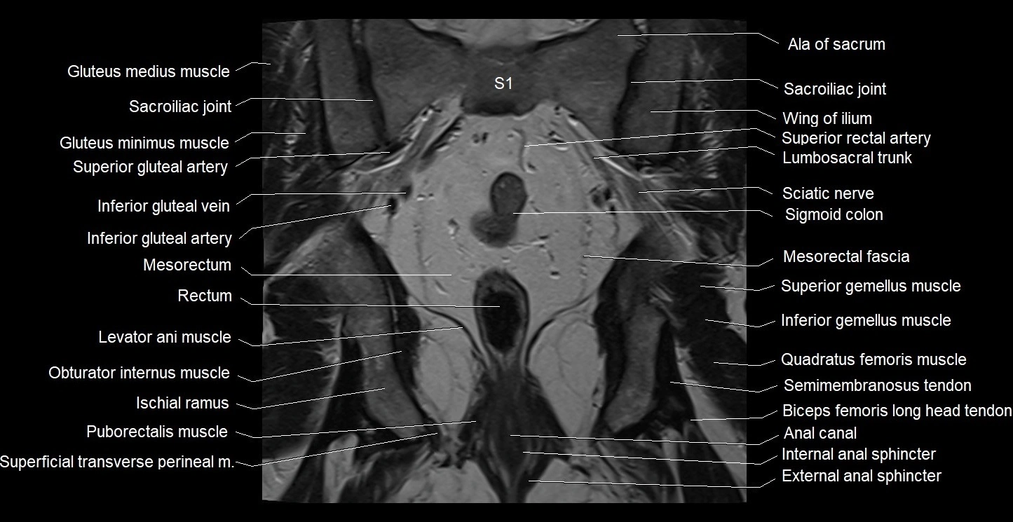 MRI coronal cross sectional anatomy male pelvis image 28.webp